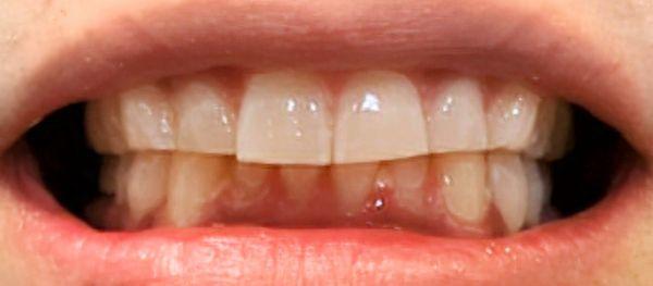 After in office whitening, under an hour from start to finish.