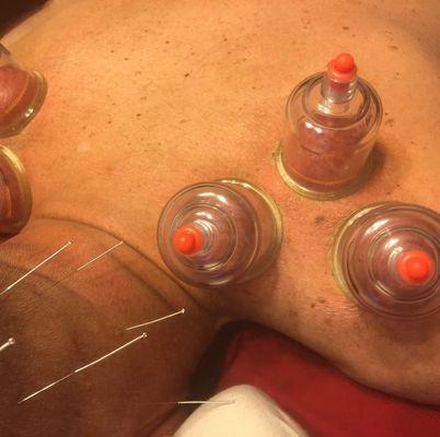 Enjoy acupuncture and cupping during your next session here at Moroso Medical Center.