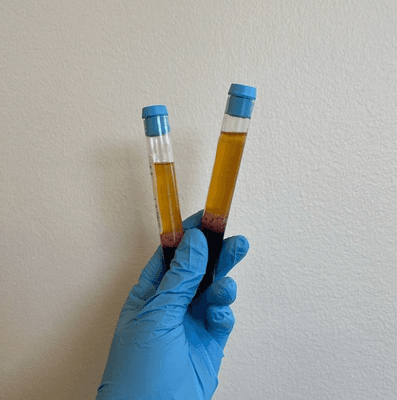 Platelet rich plasma (PRP). Loaded with growth factors to increase healing benefits of Prolotherapy regenerative joint injections!