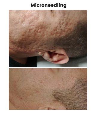 Microneedling helps with what we call "ice pick" scars.