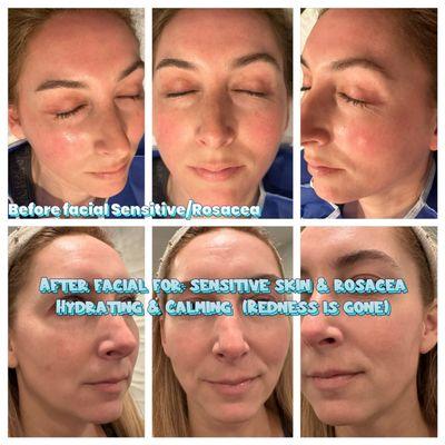 facial on sensitive skin hydration & tightening