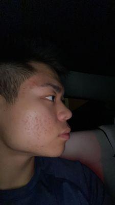 after ONLY 2 treatments. Minimal active acne, only acne scars and hyperpigmentation.