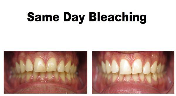 Ask about our same day bleaching!