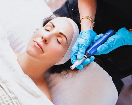 Microneedling treatments