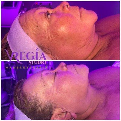 Maderoterapia facial 
Disminuye líneas de expresión 
Rejuvenecimiento facial 
Aclara la piel 
Disminuye papada