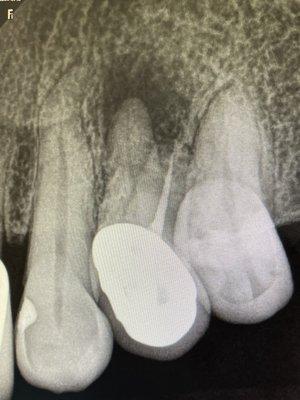 #12 tooth, first upper left bicuspid, only one of the root's was "fixed" the other became infected and had to be corrected