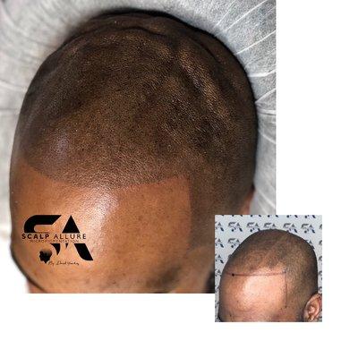 Scalp micro pigmentation clinic in Rockville, Maryland