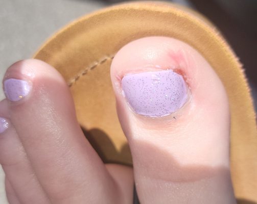 Ouch, big toe immediately after pedicure