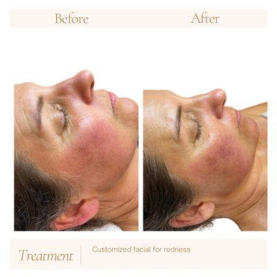 Customized facial- reduced redness