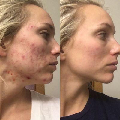 PCA Acne Peel Series - 4 Sessions