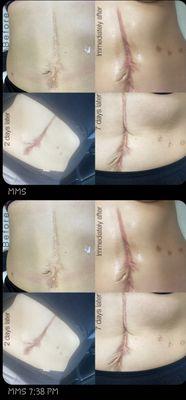 Scar treatment