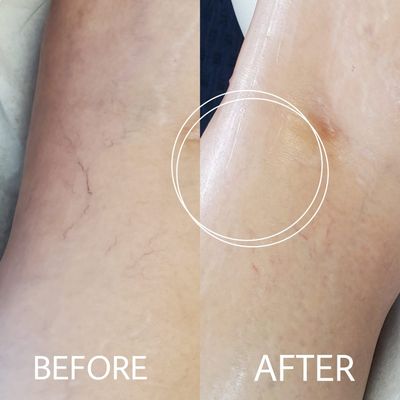 Spider veins removal by Mariya