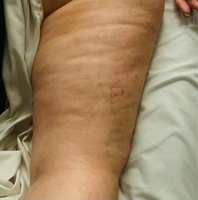 Edema, compare the differences before treatment and after only one session.