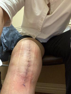 Total knee replacement cared for by Chad Uffelman and Jaylynn