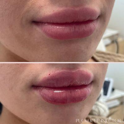 Let's give those lips a little love!  With numbing cream and a gentle nerve block, I'll make your lip journey smooth sailing!