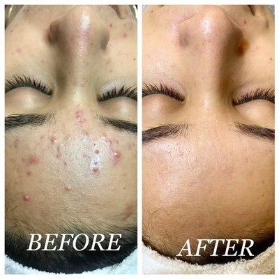 Acne Solutions Skin Care & Spa