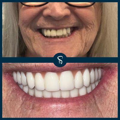 Before and After of Dental Implants