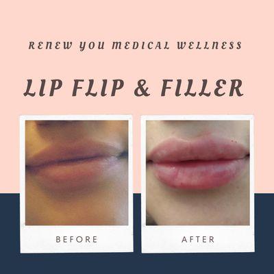 Plump your lips with filler for the look you're seeking