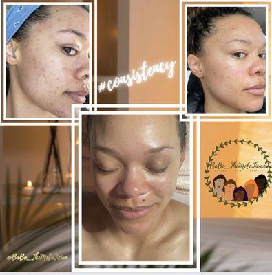 SkinTox facial focused on acne skin and pigmentation