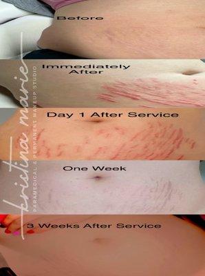 Inkless Stretch Mark Revision