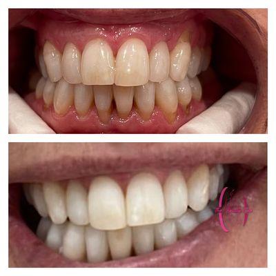 Cosmetic teeth whitening treatments just before the holidays