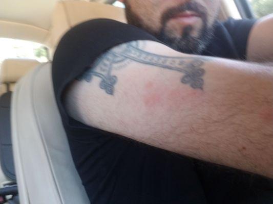 More bed bug bites