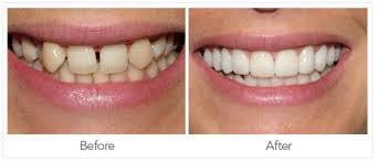 Whiter teeth makes a youthful smile !!!   Call and see how easy it can be done