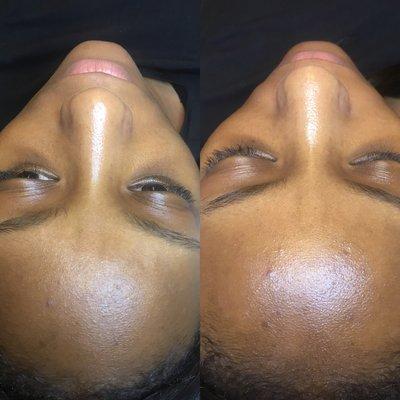 Dermaplaning before (left) and after (right.)