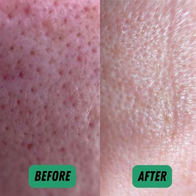 Before & immediately after the Microderm facial.