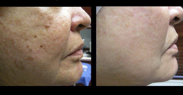 PRP Microneedling / Vampire Facelift