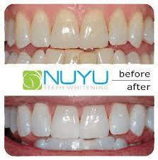 Teeth Whitening for $99.00