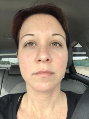 My face is a deep red color all over due to rosacea. Spot on right cheek is normally deep red/purple. This picture is 20 min after 1 visit.