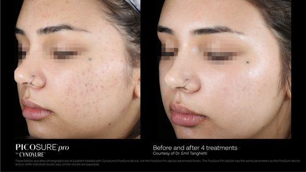 Before and after treatment for acne scar and skin resurfacing