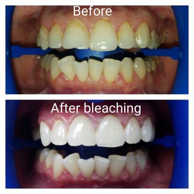 Before and After Bleaching