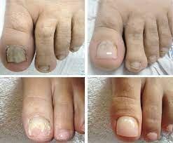 Before and After toenail reconstruction. Toenail reconstruction on missing or damaged toenails. Comfortable alternative cosmetic repair.