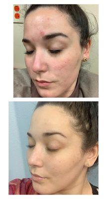 Before and after monthly facials at Glo!