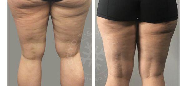 Cellulite treatment before and after