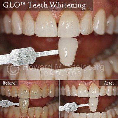 GLO™ Teeth Whitening in Tucson, AZ