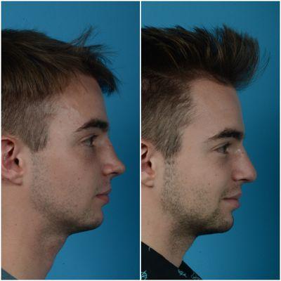 Before & After Rhinoplasty/Septoplasty