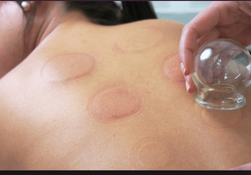 cupping