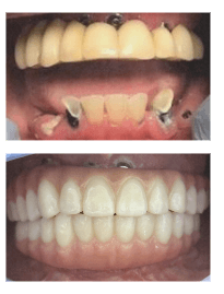 Before and after double All on 4 full arch implant treatment