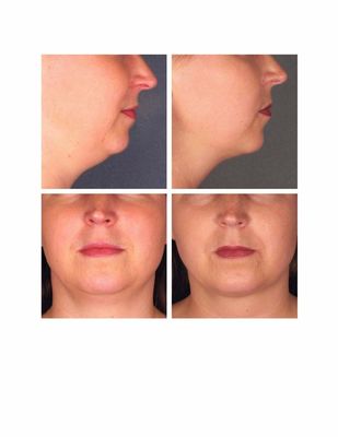 Kybella for a Sculpted Jawline