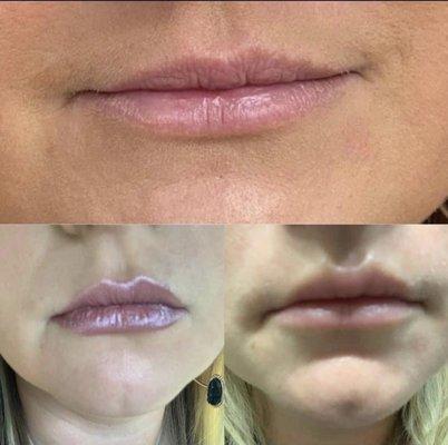 Lip Flip $75; Top (before); bottom (after)