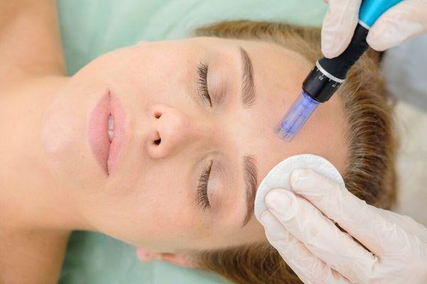 Micro needling with and with out PRP (protein rich plasma)