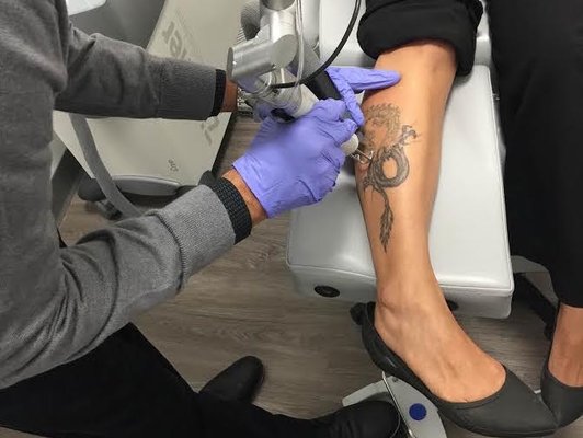 Removery Tattoo Removal & Fading