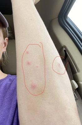 BED BUG BITES in characteristic linear pattern L forearm