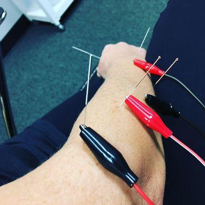 Acupuncture treatment for "Tennis Elbow"