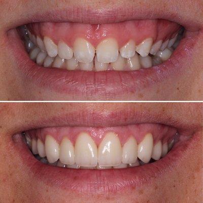 Veneers, Crowns, Smile Makeover