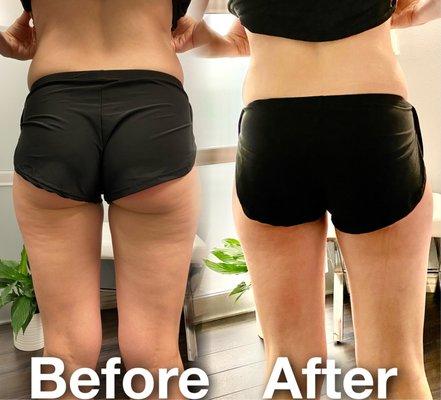 Cellulite Treatment