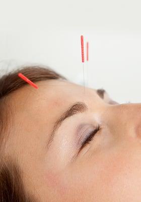 Acupuncture